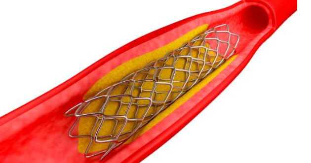 低温日本午夜福利视频APP技术对心血管支架药物涂层均匀性和牢固度提升-午夜精品久久久午夜电影网站机
